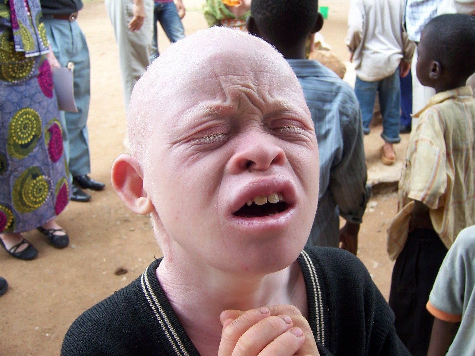 Santé : L’albinisme, une anomalie et non une malédiction￼